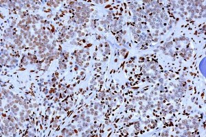 Expressión de 5-hidroxi-metil-Citosina en células tumorales detectada mediante inmunohistoquímica Expressión de 5-hidroxi-metil-Citosina en células tumorales detectada mediante inmunohistoquímica